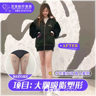 廣州藝美整形李向陽大腿吸脂案例 廣州藝美整形李向陽大腿吸脂案例
