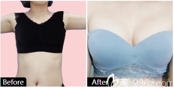 廣州藝美整形李向陽醫(yī)生隆胸案例 廣州藝美整形李向陽醫(yī)生隆胸案例