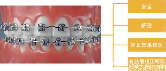 武漢壹加壹金屬自鎖托槽矯正優(yōu)勢(shì)