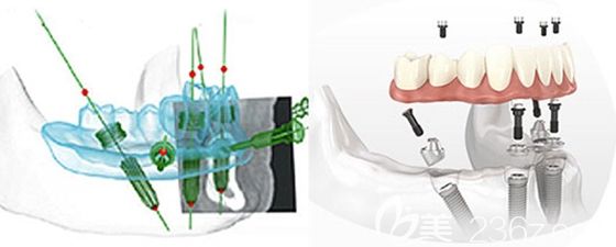 張達良醫(yī)生介紹成都茁悅口腔的All-on-4即刻種植牙的優(yōu)勢