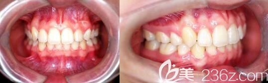 這是我25歲在北京佳美口腔戴金屬自鎖牙套矯正虎牙前后對(duì)比照片,求評(píng)價(jià)成年人虎牙矯正效果好嗎