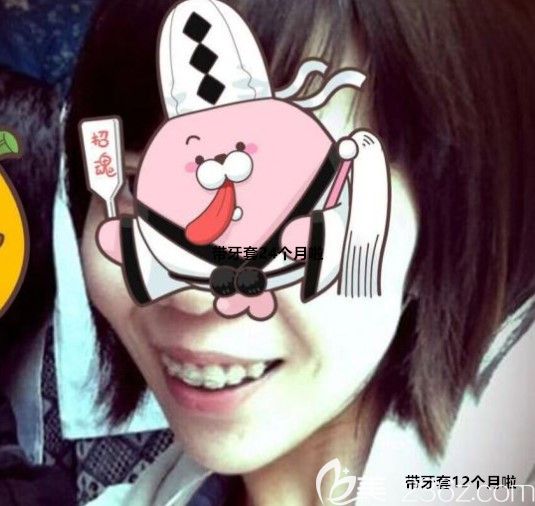 帶陶瓷半隱形牙套12個月