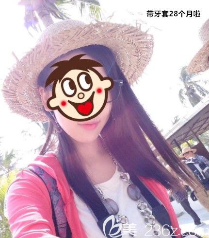 突嘴齙牙在北京西諾口腔戴陶瓷半隱形牙套矯正28個月，親身經歷驗證正畸可以改善嘴凸不