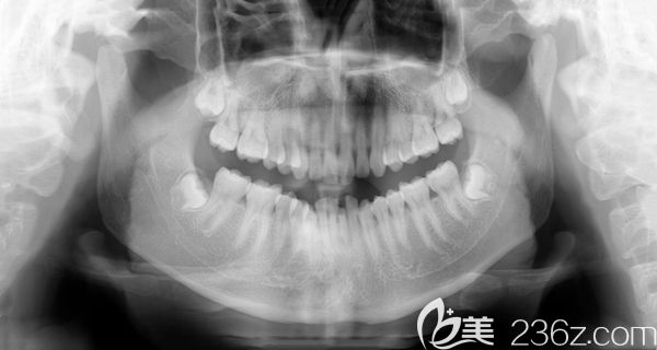 門牙齙牙拍片圖