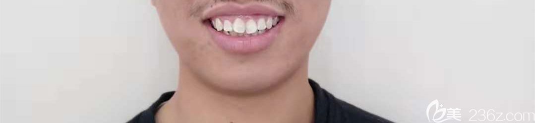 牙齒矯正前圖示