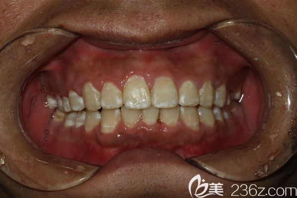 在廣州陽(yáng)光樹口腔做完牙齒矯正樣子