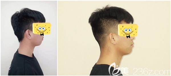 男朋友深覆蓋矯正前后臉型變化