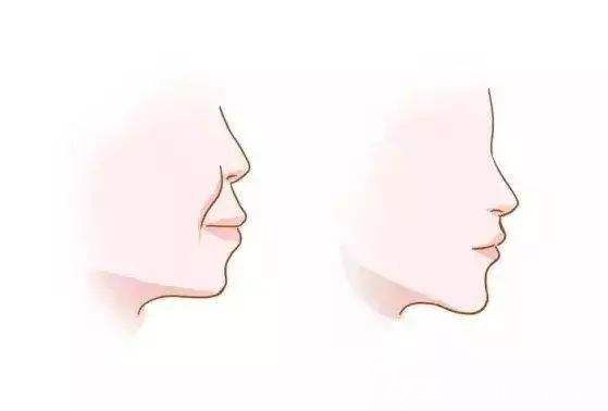 深覆蓋矯正后臉型變化圖