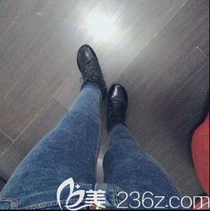 我在北京藝美做腿部吸脂第35天效果