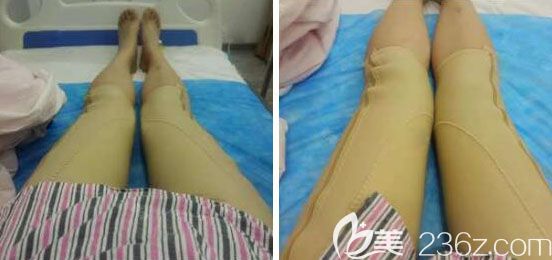 武漢壹加壹水動(dòng)力大腿吸脂術(shù)后第1天恢復(fù)圖