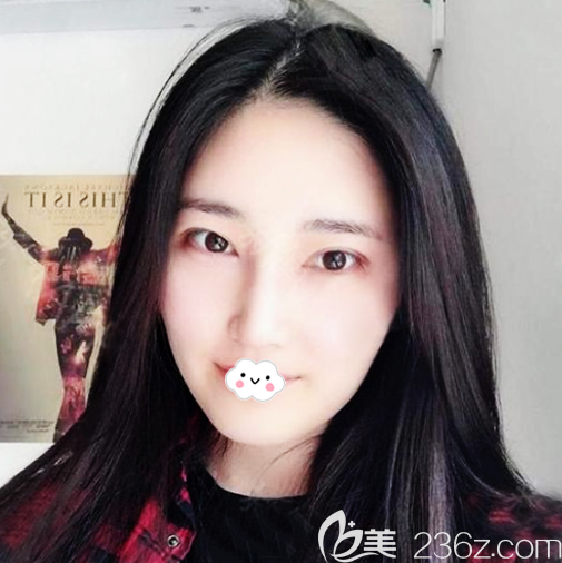 <!--<i data=20240703-sp></i>-->整形醫(yī)院羅志敏鼻綜合隆鼻案例 <!--<i data=20240703-sp></i>-->整形醫(yī)院羅志敏鼻綜合隆鼻案例