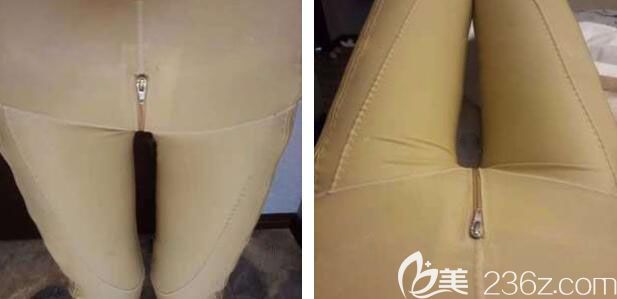 李艷東水動(dòng)力大腿吸脂真人案例恢復(fù)過程圖