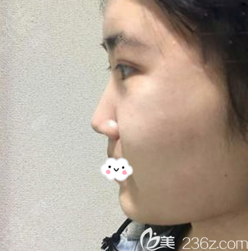 在<!--<i data=20240703-sp></i>-->醫(yī)院做鼻子術(shù)前照片 在<!--<i data=20240703-sp></i>-->醫(yī)院做鼻子術(shù)前照片