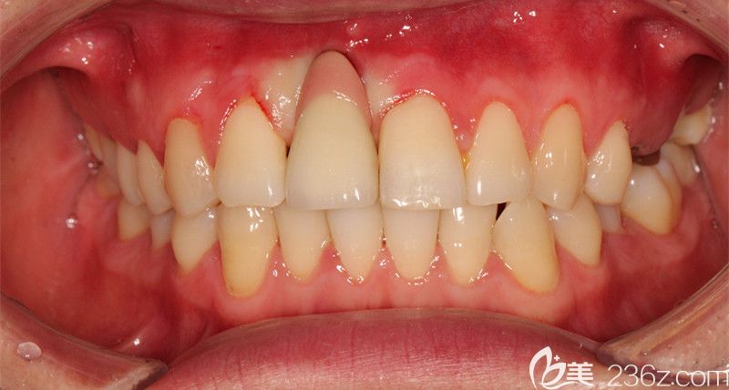 種植牙中的照片