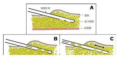 大腿吸脂的手術(shù)原理