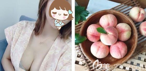 找焦俊光院長(zhǎng)做脂肪豐胸一個(gè)月的效果圖