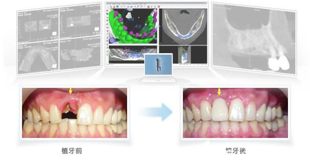 深圳徠可口腔種植牙 深圳徠可口腔種植牙