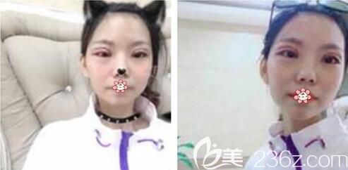 李曾顯醫(yī)生給我做完手術(shù)后5天