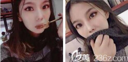 這次在重慶好美整形李曾顯那兒做全切雙眼皮修復(fù)對(duì)我來(lái)說(shuō)是一個(gè)奇妙而珍貴的回憶