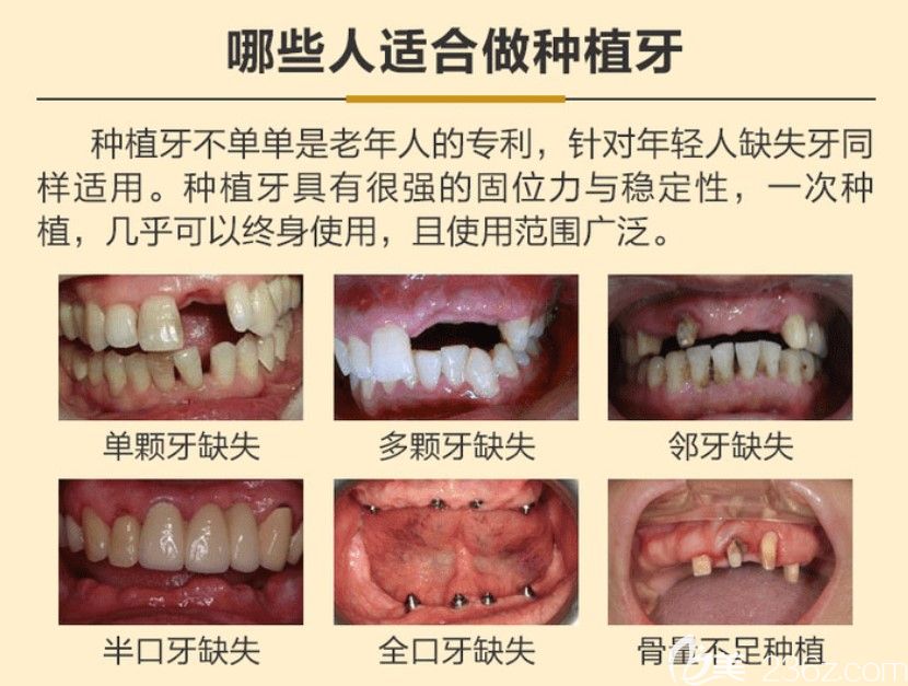 哪些人適合做種植牙