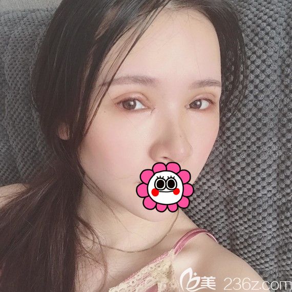 恢復(fù)5天的雙眼皮消腫了不少