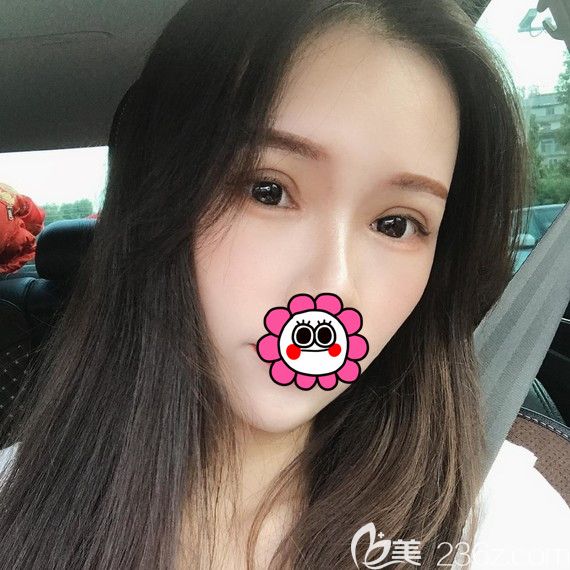 杭州維多利亞雙眼皮恢復(fù)一個(gè)月效果