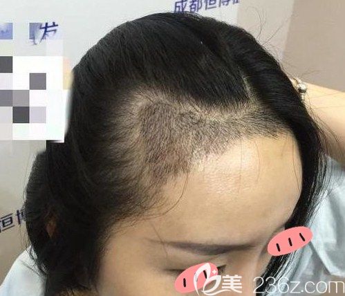 禿頭妹來成都恒博植發(fā)做完M型發(fā)際線移植后各種發(fā)型都可輕松駕馭