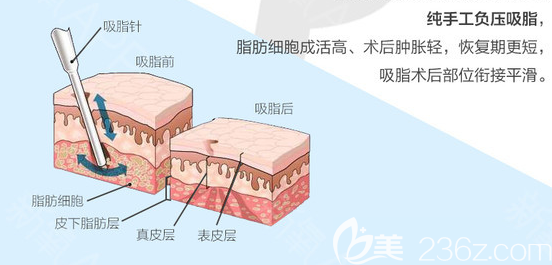 深圳南雅整形醫(yī)院張燕發(fā)吸脂手術(shù)原理圖 深圳南雅整形醫(yī)院張燕發(fā)吸脂手術(shù)原理圖