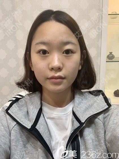 艾恩整形術(shù)前生活照 艾恩整形術(shù)前生活照