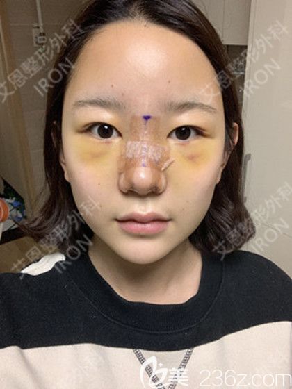 艾恩整形術(shù)后第7天 艾恩整形術(shù)后第7天