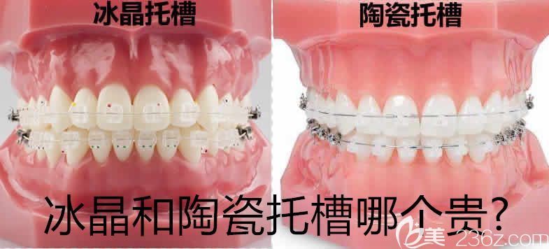 要問冰晶和陶瓷托槽哪個貴?其實(shí)深圳美萊口腔冰晶與陶瓷牙套價格差也就7000多元