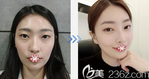 純真雙眼皮案例