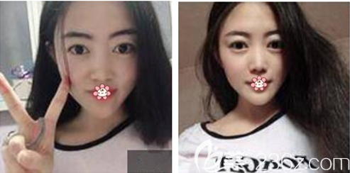 <!--<i data=20240703-sp></i>-->內(nèi)切祛眼袋術(shù)后半個月