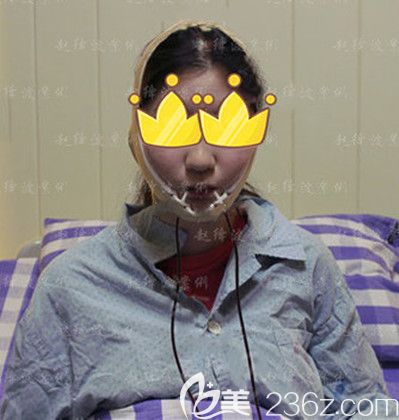 做完下頜角整形手術(shù)當(dāng)天