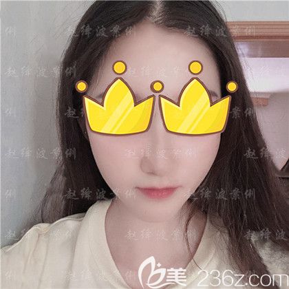 下頜角整形手術(shù)1個(gè)月