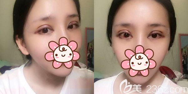 切開(kāi)雙眼皮+開(kāi)內(nèi)眼角+去脂的眼部綜合術(shù)后即刻 切開(kāi)雙眼皮+開(kāi)內(nèi)眼角+去脂的眼部綜合術(shù)后即刻