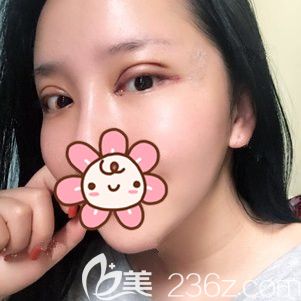 術(shù)后三天眼部整形恢復(fù)效果 術(shù)后三天眼部整形恢復(fù)效果