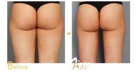 商丘冰薇分層立體吸脂