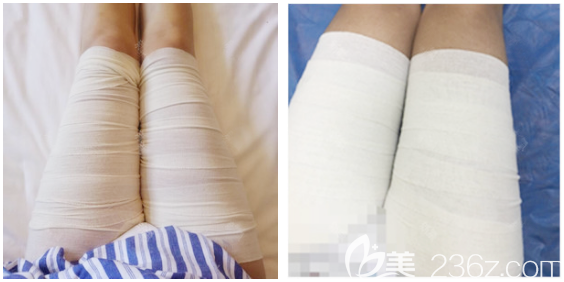 深圳富華大腿抽脂5天恢復(fù)效果