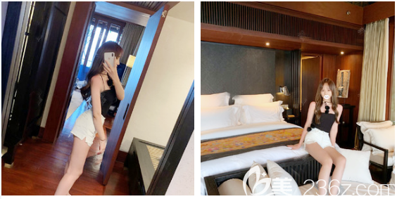 大腿吸脂術(shù)后兩個(gè)月反饋照片