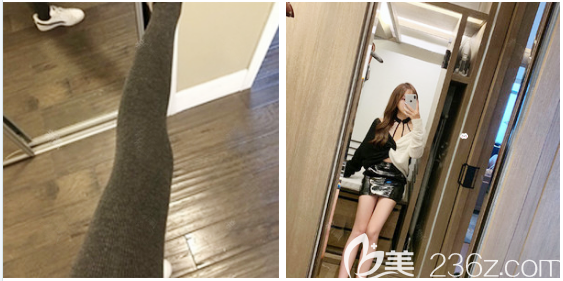 深圳富華大腿吸脂術(shù)后一個(gè)月效果圖