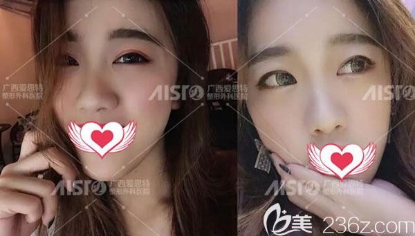 廣西內(nèi)切祛眼袋案例來報到，說一下我是在南寧愛思特做的手術(shù)