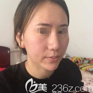 術(shù)前面部凹陷明顯顯老 術(shù)前面部凹陷明顯顯老