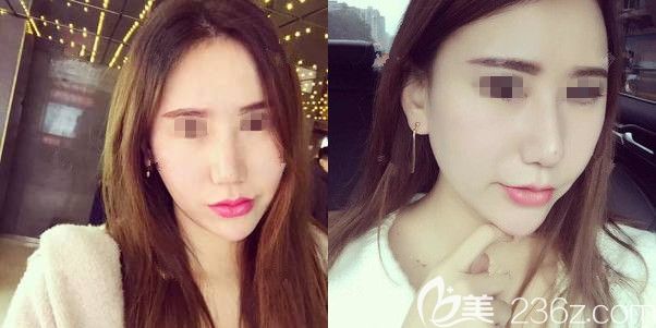 全麻做的自體脂肪面部填充全臉到今天一個月了