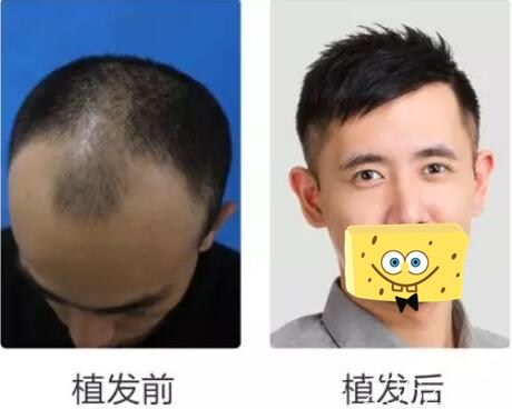 濟(jì)南名韓發(fā)際線種植效果圖 濟(jì)南名韓發(fā)際線種植效果圖