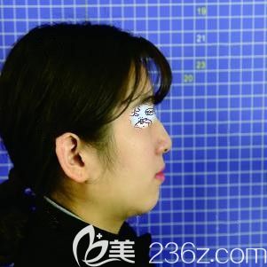 到合肥韓美整形做假體墊下巴術(shù)前的自己 到合肥韓美整形做假體墊下巴術(shù)前的自己