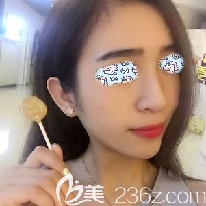 閆醫(yī)生做假體墊下巴術(shù)后42天假體恢復(fù)自然 閆醫(yī)生做假體墊下巴術(shù)后42天假體恢復(fù)自然