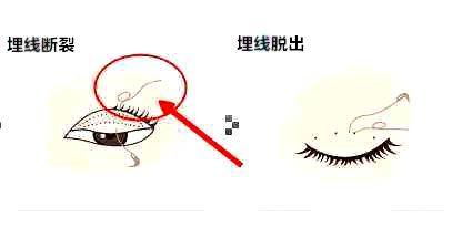 埋線斷裂、脫出