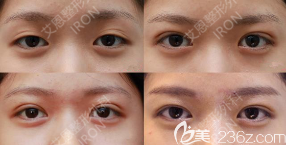 金承俊院長雙眼皮案例