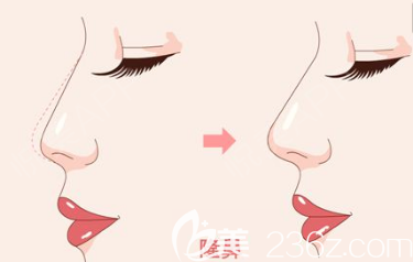 隆鼻前后對比圖